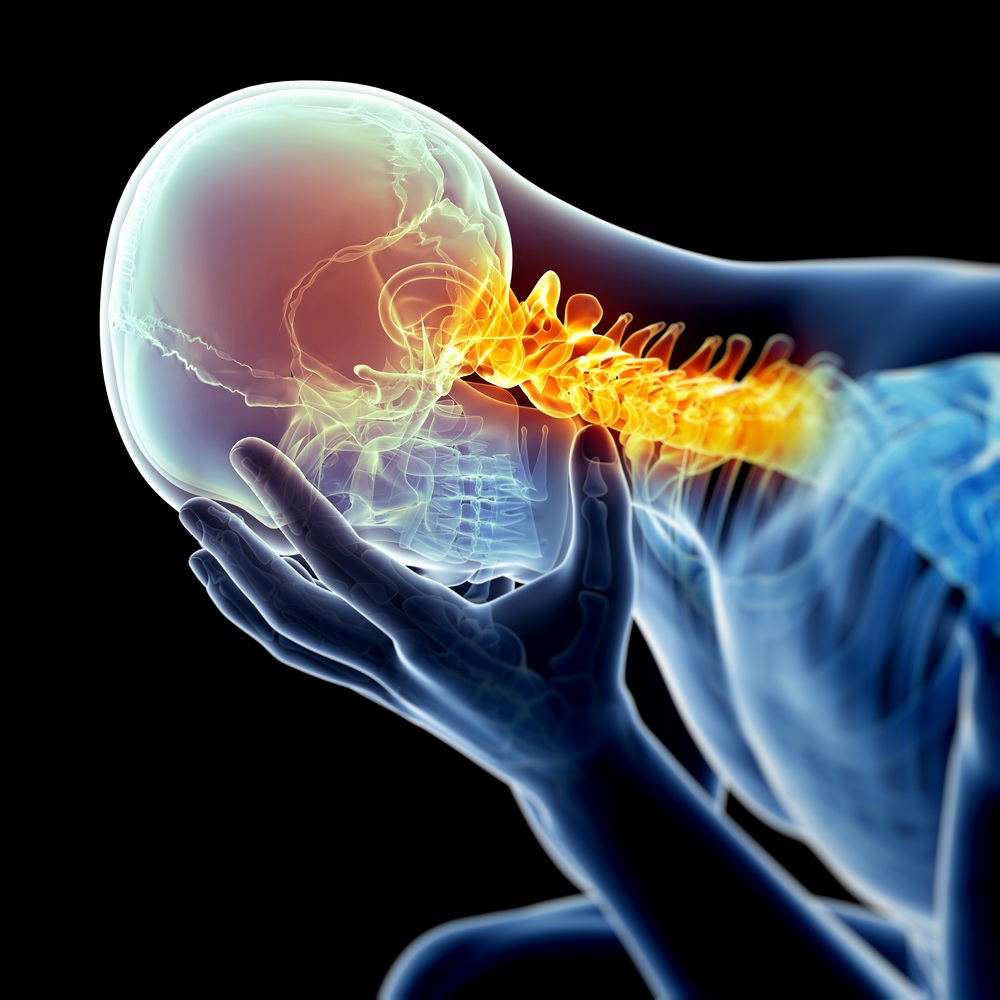 Cervicogenic Headache Causes and Treatments Chatfield Family